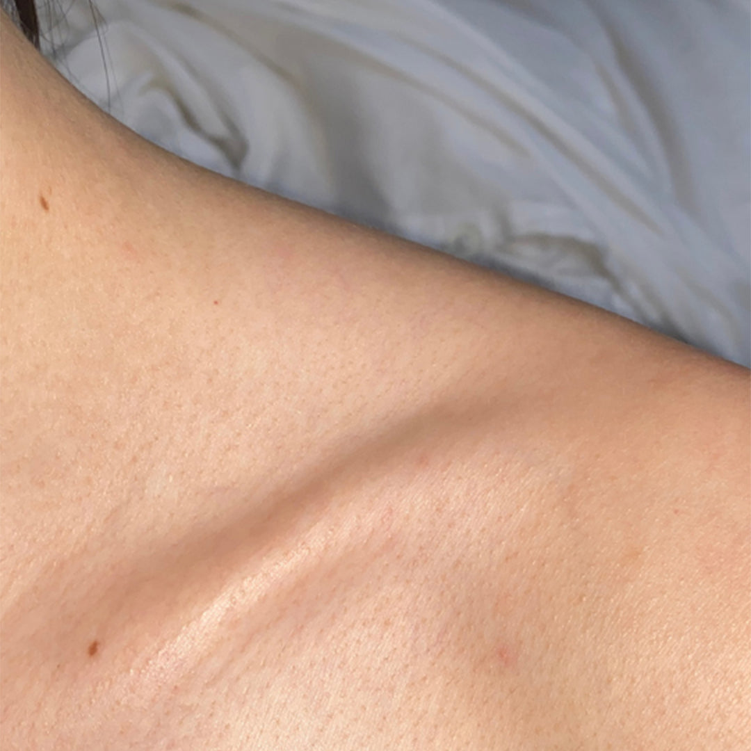 After using the frank body Acid Heroes Kit: clear, smooth skin across the shoulder and upper arm.