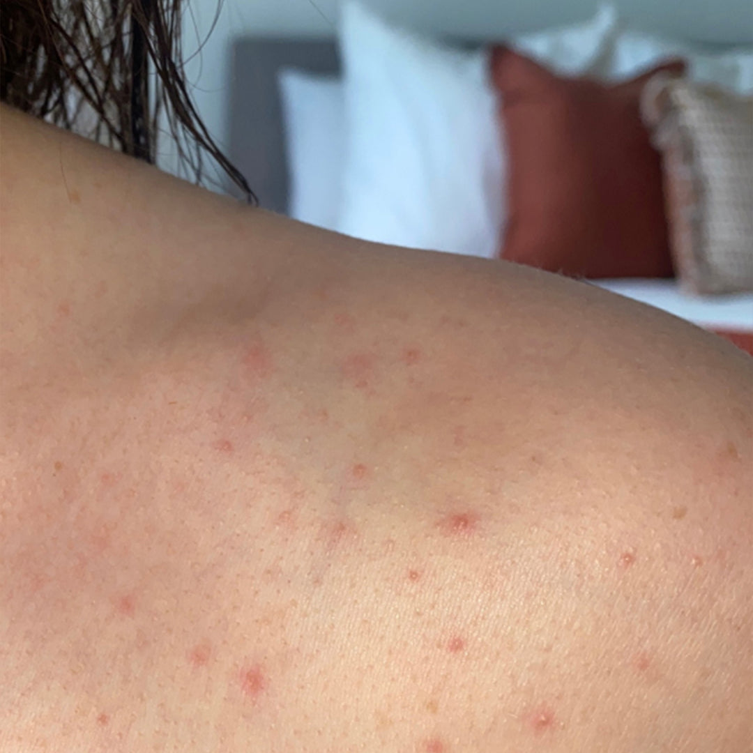 Before using the frank body Acid Heroes Kit: red breakouts scattered across the shoulder and upper arm.
