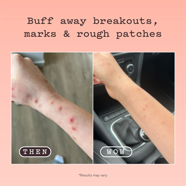 A before-and-after comparison graphic showing a person's forearm with red acne-like blemishes labeled 'THEN' on the left and clearer skin labeled 'WOW' on the right, under the headline 'Buff away breakouts, marks & rough patches' on a peach background.